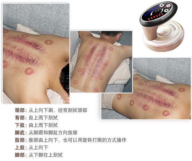 女生美容院拔罐后变紫薯精，女生美容院拔罐后变身紫薯精的神秘经历