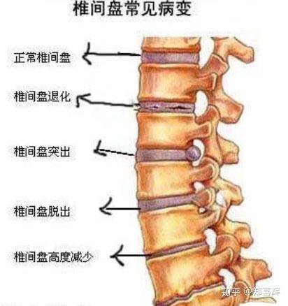 腰椎间盘突出最新治疗法，与自然和谐共舞，重拾心灵宁静新旅程