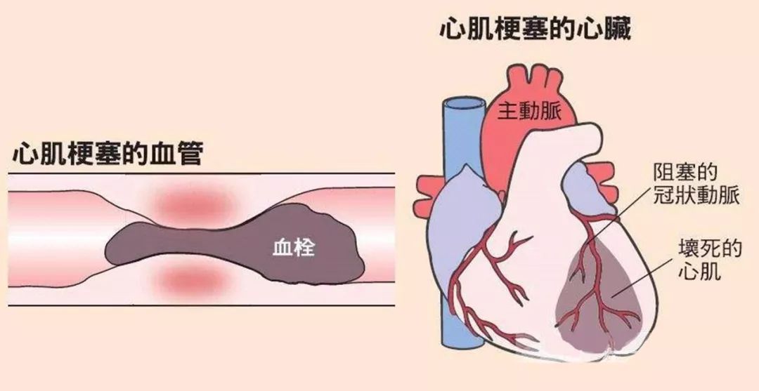 咳嗽引发心梗，潜在健康危机需警惕