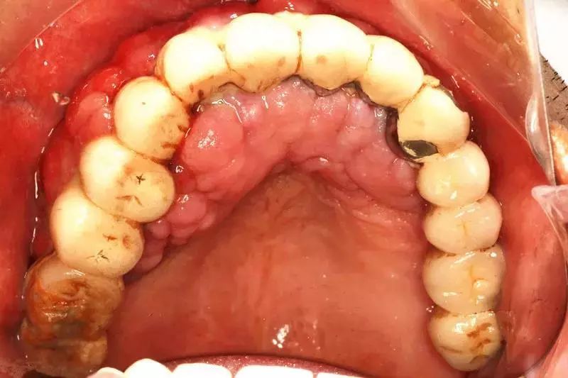 牙龈渗出血不断，牙龈渗出血是啥原因 