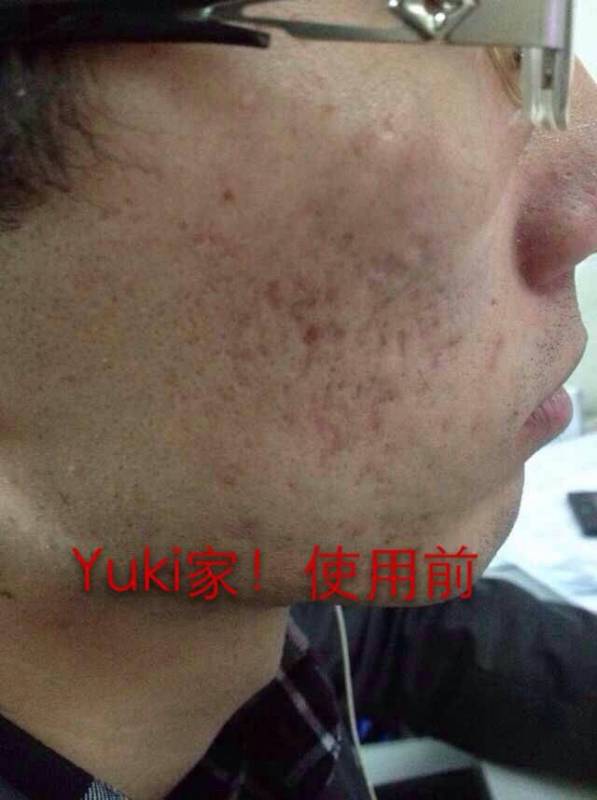 男生脸部反复长痘解决方法