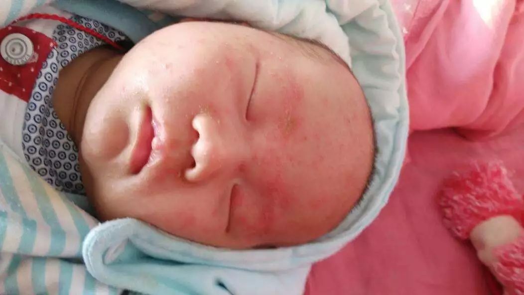 幼儿腿部突发大片红疹，家长务必警惕，原因与应对之策