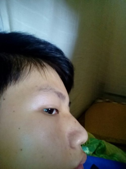 人脸上不断长痣好不好，脸上不断长痣怎么办 