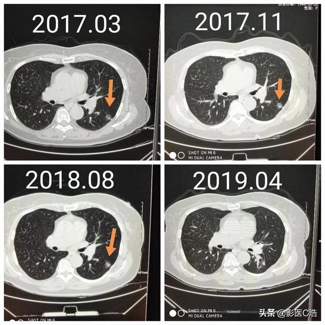 结节不断增加原因有哪些，结节一直长大是不是很危险 