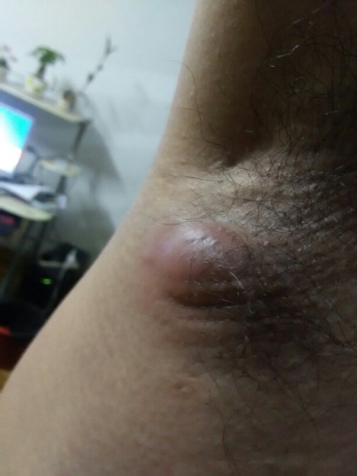 腋窝肿块不断长大，腋下经常长肿块然后又消散 
