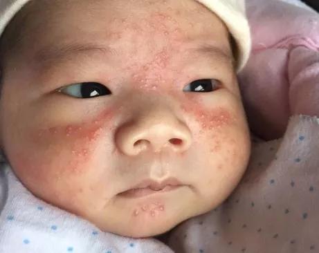 婴儿面部突发红肿图片，婴儿脸部红肿怎么办 