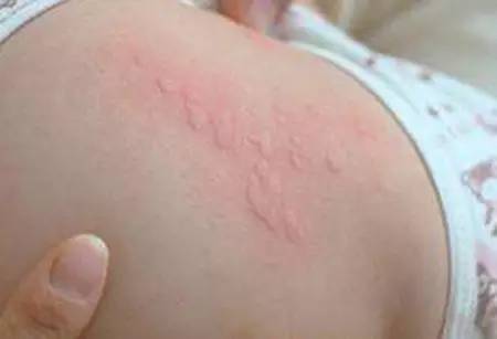 突发性风团，突发风疹怎么办 