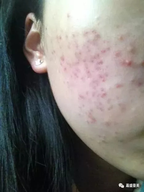 突发白头粉刺，爆发白头粉刺 