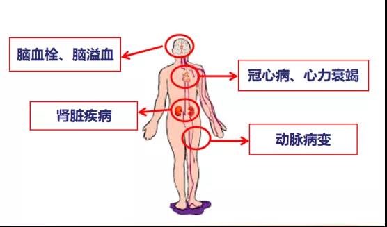 高血压突发变成200，平时高血压,突然升高200多 